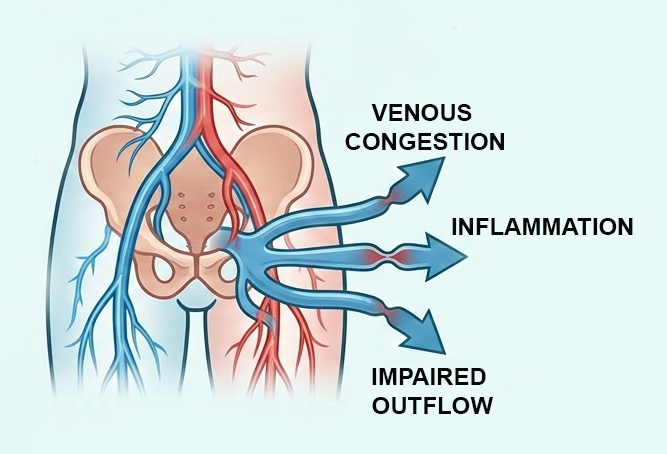 hemorrhoids-prostatitis